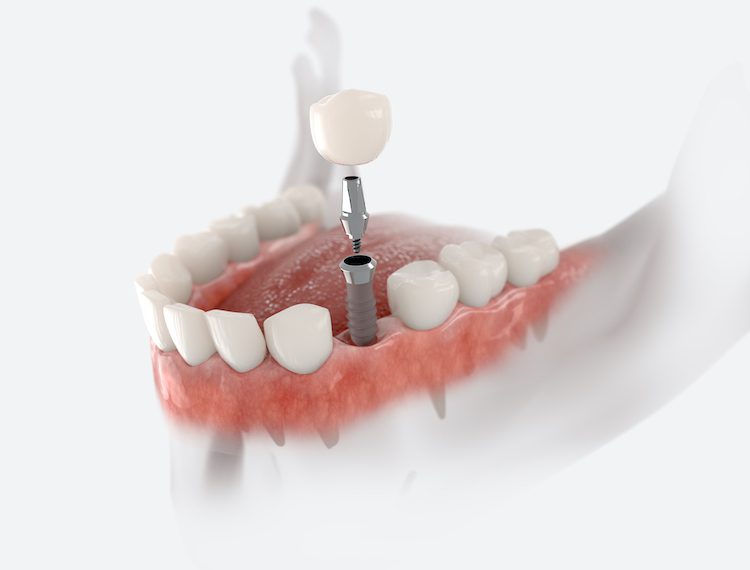 By choosing dental implants, you could maintain a youthful appearance and prevent worsening conditions often associated with missing teeth.