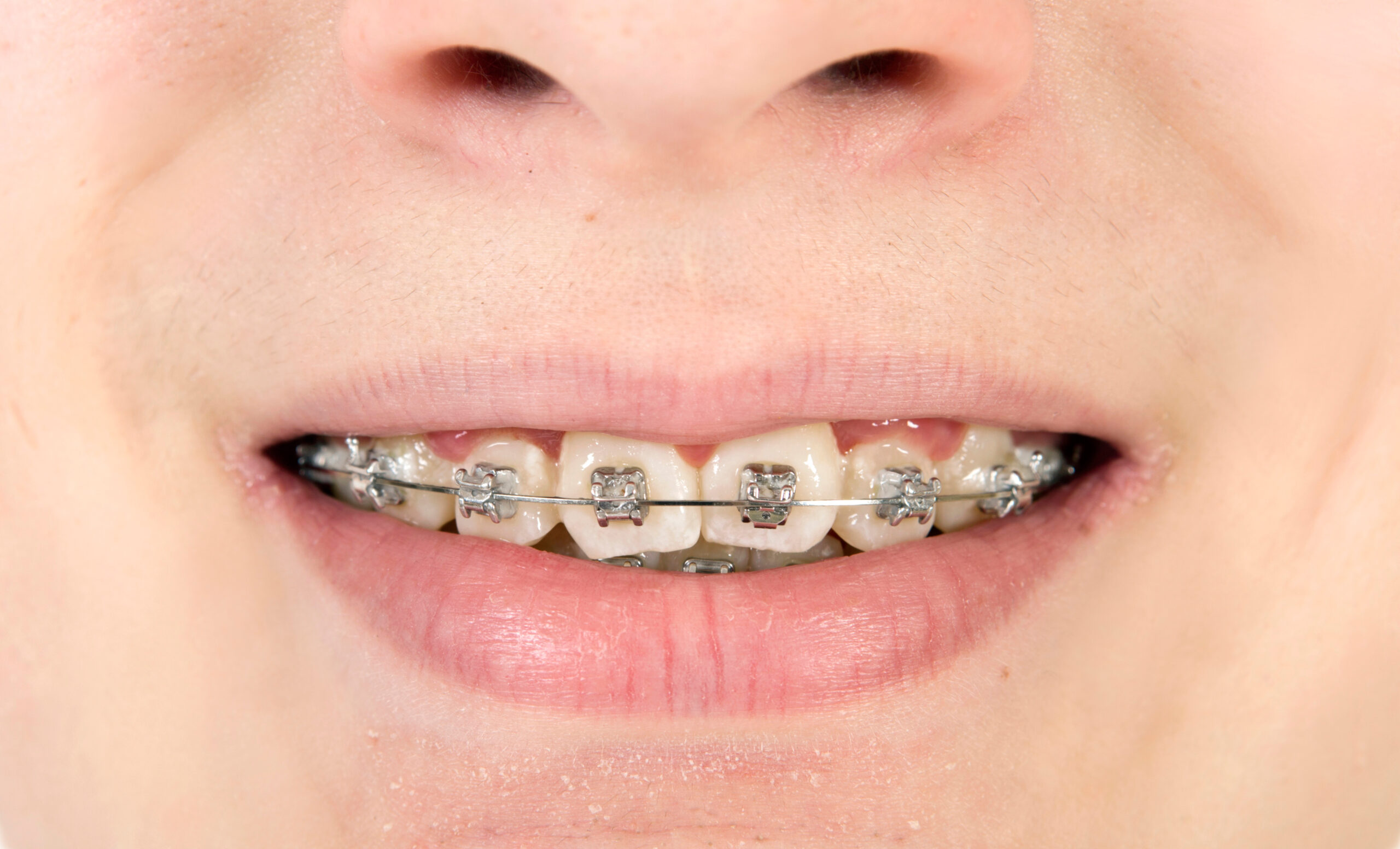 How to Fix White Spots After Braces
