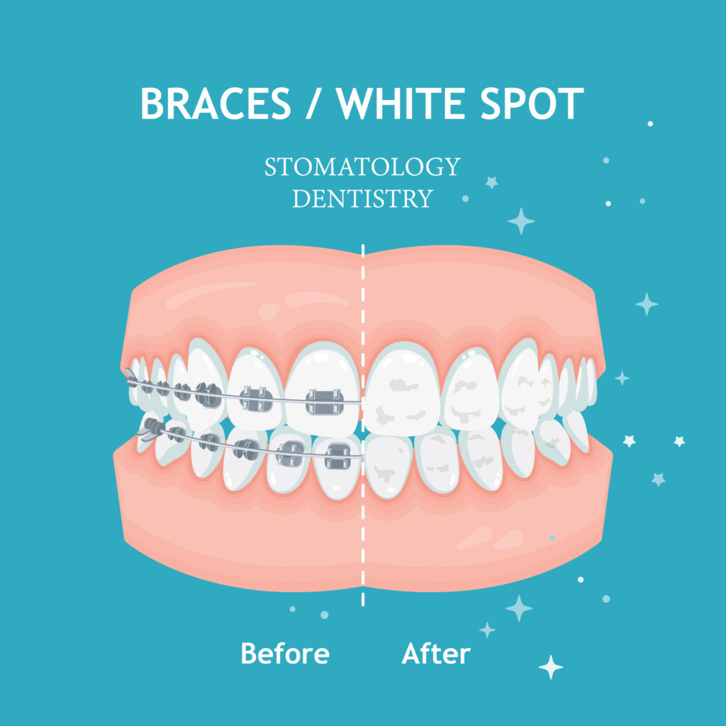 How to Fix White Spots After Braces