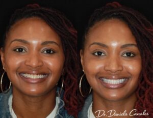 Whitening before and after