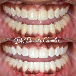 Whitening before and after